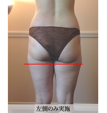 美脚O脚