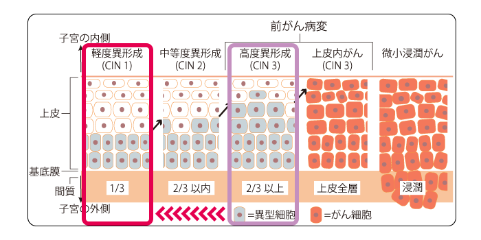 子宮頸がん&nbsp;高度異形成